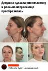 Прикрепленное изображение: Девушка сделала ринопластику.jpg